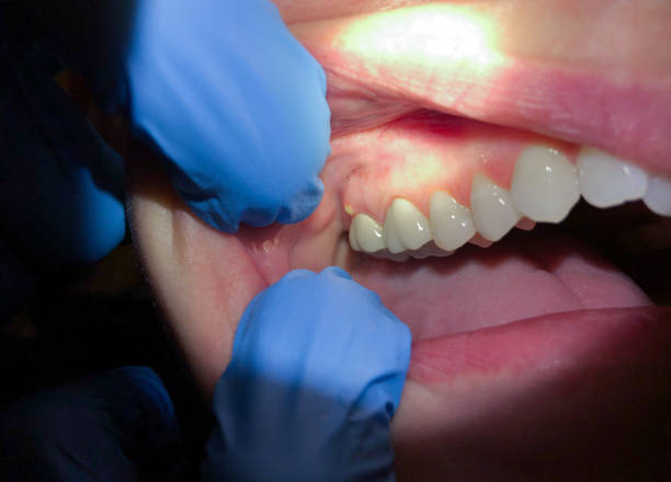 Best Emergency Root Canal Treatment in Dobson, NC