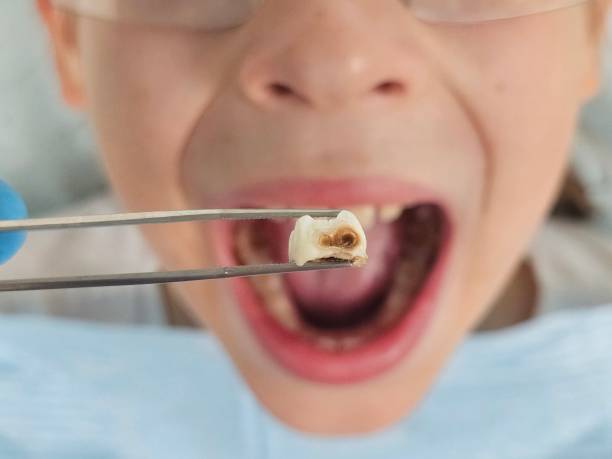 Best Emergency Dental Extractions in Dobson, NC